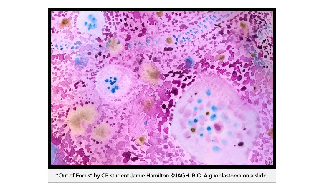 "Out of Focus" by CB student Jamie Hamilton @JAGH_BIO. A glioblastoma on a slide.